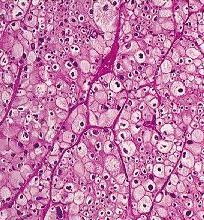 Oncocitoma renal x CCR cromófobo Núcleos redondos e regulares com pequenos