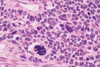 Anaplasia: 5% dos tumores Células
