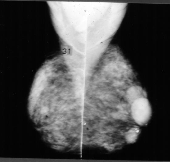 CARACTERÍSTICAS MAMOGRAFIA FONTE: