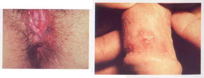 Fotos Herpes Genital O Herpes é uma doença que não