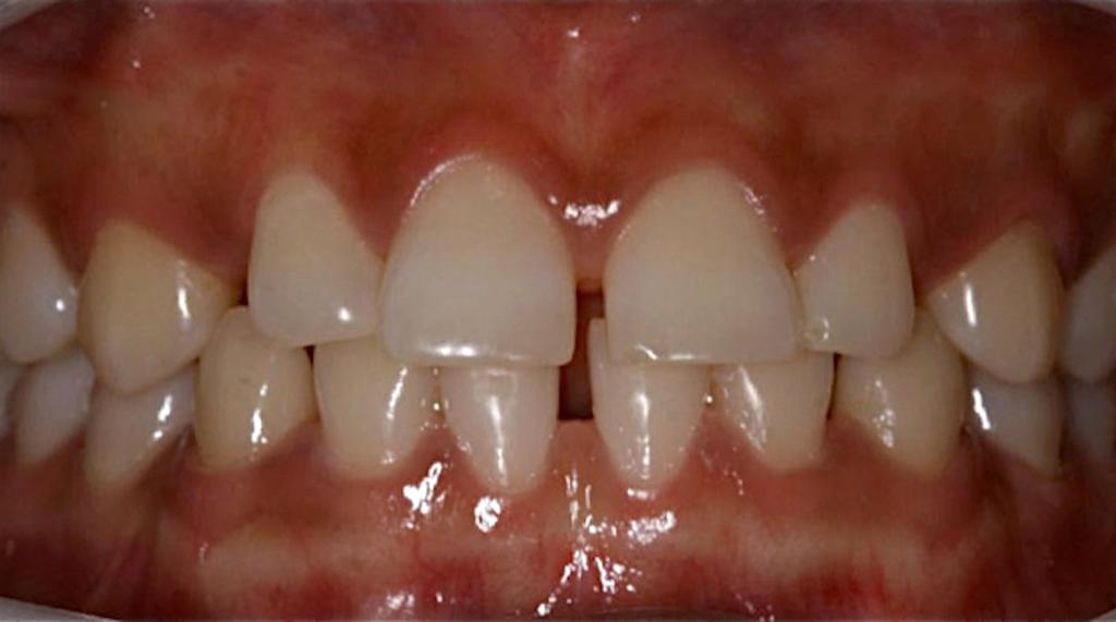 em áreas papilares, onde acaba por cobrir boa parte da coroa dental, resultando em sua menor exposição.