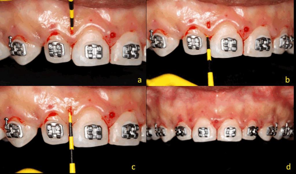 Para a antissepsia intraoral utilizou-se o bochecho de solução digluconato de clorexidina a 0,12% e posteriormente foi executada a anestesia por bloqueio regional dos nervos infraorbitário e palatino