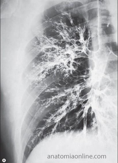Sistema Respiratório Broncograma