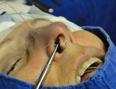 21 3.3 Descrição de técnica A sutura intercrura mediais é realizada após descolamento do bolsão columelar, com fio Nylon incolor 4.0, conforme figuras abaixo.