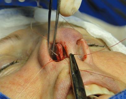 24 FIGURA 6 SUTURA INTERCRURA MEDIAIS Na sutura de rotação cefálica, realizada 5 mm abaixo do ápice da columela, a agulha é passada do bolsão para a região externa (figura 7) e retorna pelo mesmo
