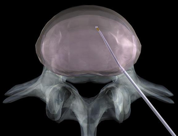 Procedimentos percutâneos Nucleoplastia por coblação ablação tecidual a frio