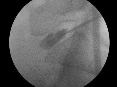 Procedimentos percutâneos Nucleoplastia por coblação discopatia dolorosa