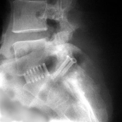 Artrodeses minimamente invasivas Mini-laminectomia com P.L.I.F.