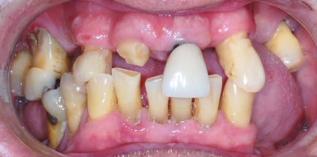 possuindo o paciente alguns dentes ausentes (12,