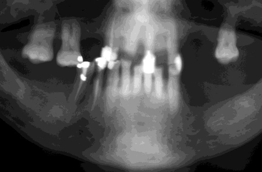13 Figura 2A Corte de radiografia panorâmica mostrando as perdas ósseas generalizadas, com alguns dentes com tratamento endodôntico e restaurações atuais antes do tratamento.