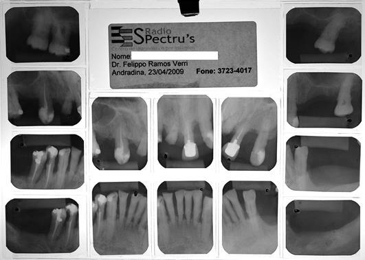 14 Figura 2B Radiografias periapicais mostrando situações individuais de cada dente analisado.
