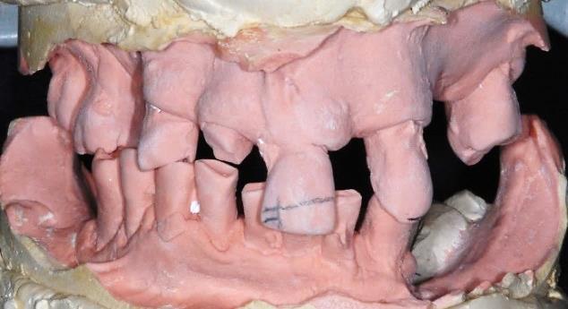 15 3.3. Procedimentos laboratoriais pré-cirúrgicos Após planejamento dos dentes suporte para a overdenture e os que vão ser extraídos foram programados os procedimentos laboratoriais prévios à cirurgia.