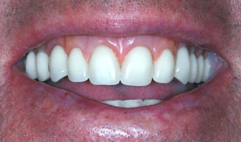 Isto está relacionado ao processo fisiológico progressivo de reabsorção do rebordo alveolar decorrente da perda dos elementos dentais.