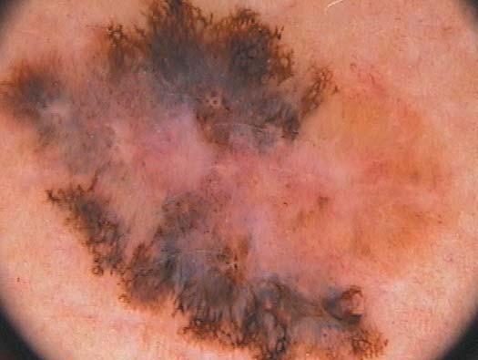 16,18 As células neoplásicas apresentaram-se confinadas à epiderme, de acordo com o conceito de que essas características dermatoscópicas estão associadas à fase de crescimento radial do melanoma.