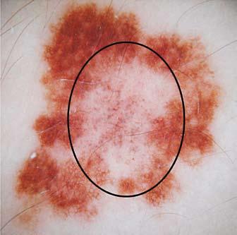 Dermatoscopia de lesões pigmentadas Fig. 9 - Vasos ramificados. Fig. 7 - Áreas hipopigmentadas.
