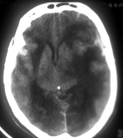 ventricular e das cisternas mesencefálicas grau de desvio da linha