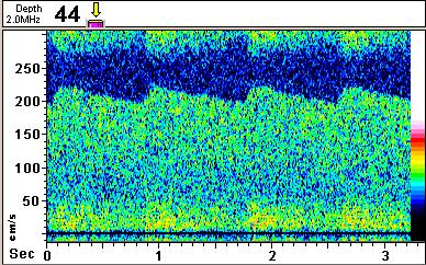 DTC Doppler Transcraniano Técnica não invasiva que mede a velocidade do fluxo sanguíneo cerebral nas principais artérias cerebrais, que é directamente proprocional ao FSC e inversamente proporcional