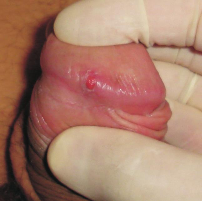 46 sic oncologia 1. Introdução As neoplasias de pele não melanoma constituem o tipo de câncer mais comum no Brasil e no mundo.