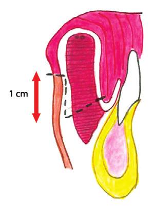 Retalho miomucoso do vermelhão associado ou não ao retalho cutâneo mentolabial na reconstrução do lábio inferior Técnica Cirúrgica As cirurgias foram realizadas sob anestesia geral e, pre viamente à
