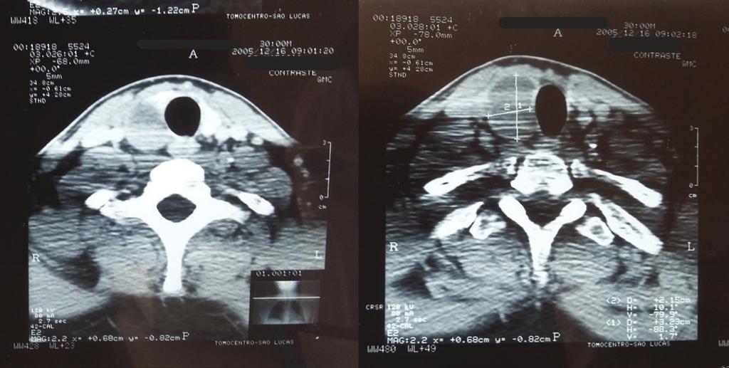 clínica é evidente e dramática 2,4,5. Dos pacientes com hiperparatiroidismo primário, o carcinoma corresponde a menos de 1% dos casos 2,5.