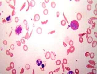 O encontro dessa forma de hemácia caracteriza a anemia falciforme e outras doenças