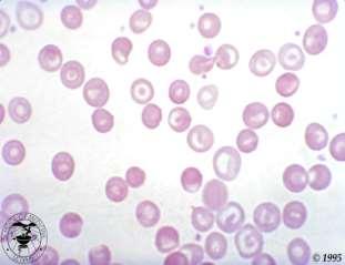 Hemácias em alvo (target cell/leptócitos/codócitos) Nesses eritrócitos a hemoglobina se concentra no centro e na periferia, deixando uma