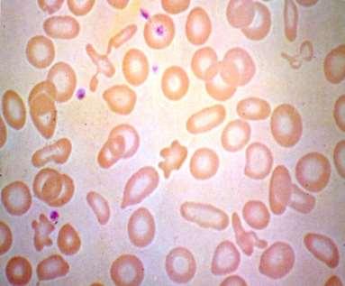 Hemácias crenadas (burr cells, equinócitos) são eritrócitos com