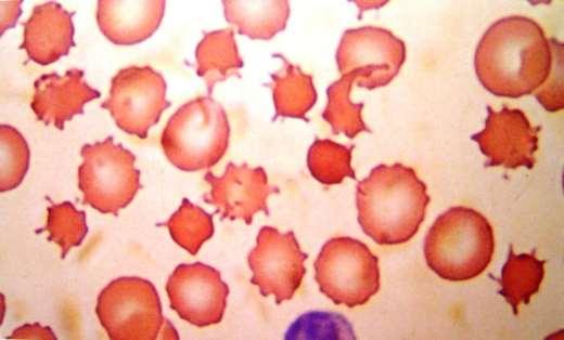Acantócitos (spurr cells) apresentam forma arredondada com proeminências pontiagudas (espículos) irregulares. São características de deficiência congênita de beta-lipoproteína (abetalipoproteinemia).