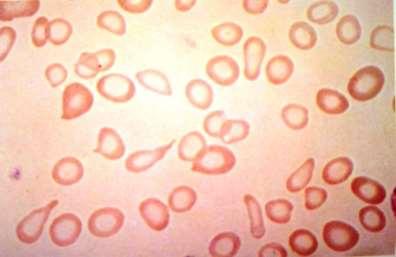 talassemias maior e menor, nas anemias hemolíticas