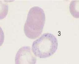O ponteado basófilo fino ou difuso é visto em várias anemias, incluindo a ferropriva, enquanto o ponteado basófilo grosseiro, após exposição ao chumbo