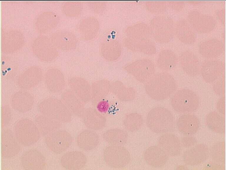 Siderócitos são grânulos de ferro dispersos de modo irregular na periferia do