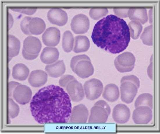 Anomalia de Alder-Reilly defeito recessivo raro da granulação de neutrófilos, sem significância patológica.