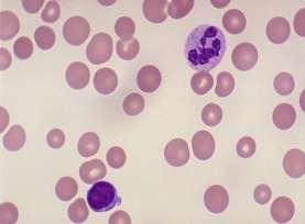 Pode ocorrer nas anemias por deficiência de vitamina B