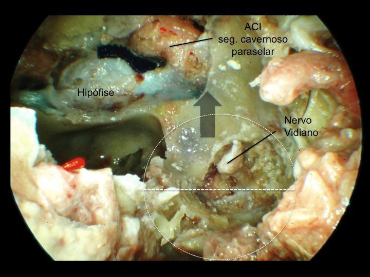 Resultados 54 Figura 25 - Exposição do joelho anterior do segmento lacerum da artéria carótida interna (ACI) ao utilizar o nervo vidiano como reparo (broqueamento inicial no quadrante