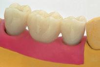 Confecção no laboratório: O revestimento dos pilares pode ser feito pela adaptação de dentes pré-fabricados ou pela modelagem directa de material sintético.