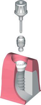 A estrutura é retirada do modelo e o pilar é solto da réplica do implante. O pilar (RN e WN) synocta 1.