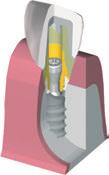 C) Colocação do restauro definitivo Ao dentista é entregue o restauro com o pilar individual e coroa no modelo mestre. O pilar individual limpo é inserido no octágono do implante sem cimento.