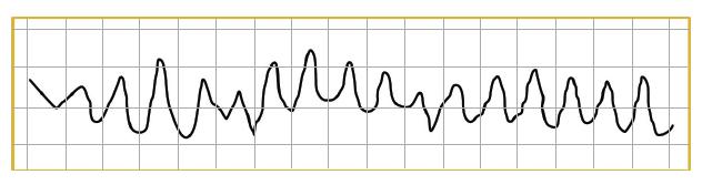 15 Fonte: UFSC, 2013, p 38. Já a TV é um conjunto de complexos QRS bizarros, ritmo regular, frequência cardíaca superior a 100 bpm, ondas P geralmente não são vistas ou não relacionadas com o QRS.