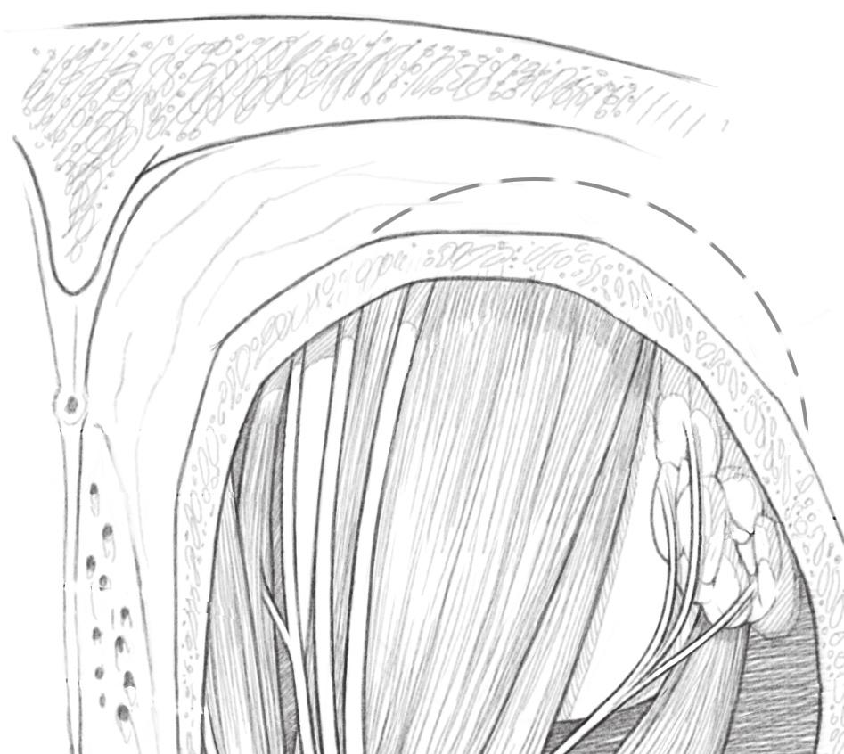 30 SEÇÃO I INTRODUÇÃO Nervo supraorbitário elevador da pálpebra superior reto superior Nervo supratroclear Glândula lacrimal reto medial oblíquo superior Nervo nasociliar reto lateral Nervo troclear