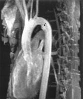 Aorta torácica RAMOS: Artérias coronárias Tronco