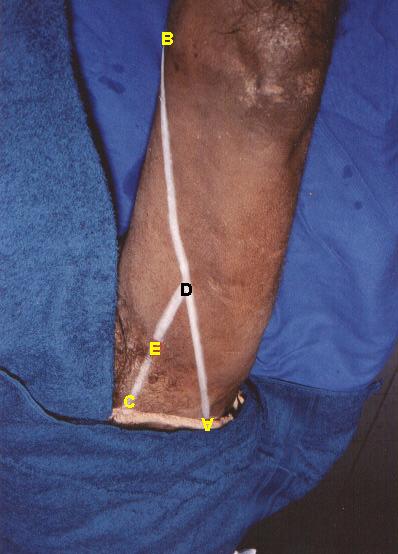 Métodos 19 Figura 3 Determinação do ponto para posicionamento do eletrodo sobre o músculo Adutor Longo A: Espinha Ilíaca antero-superior B: tubérculo adutor D: M1, ponto médio entre a espinha ilíaca