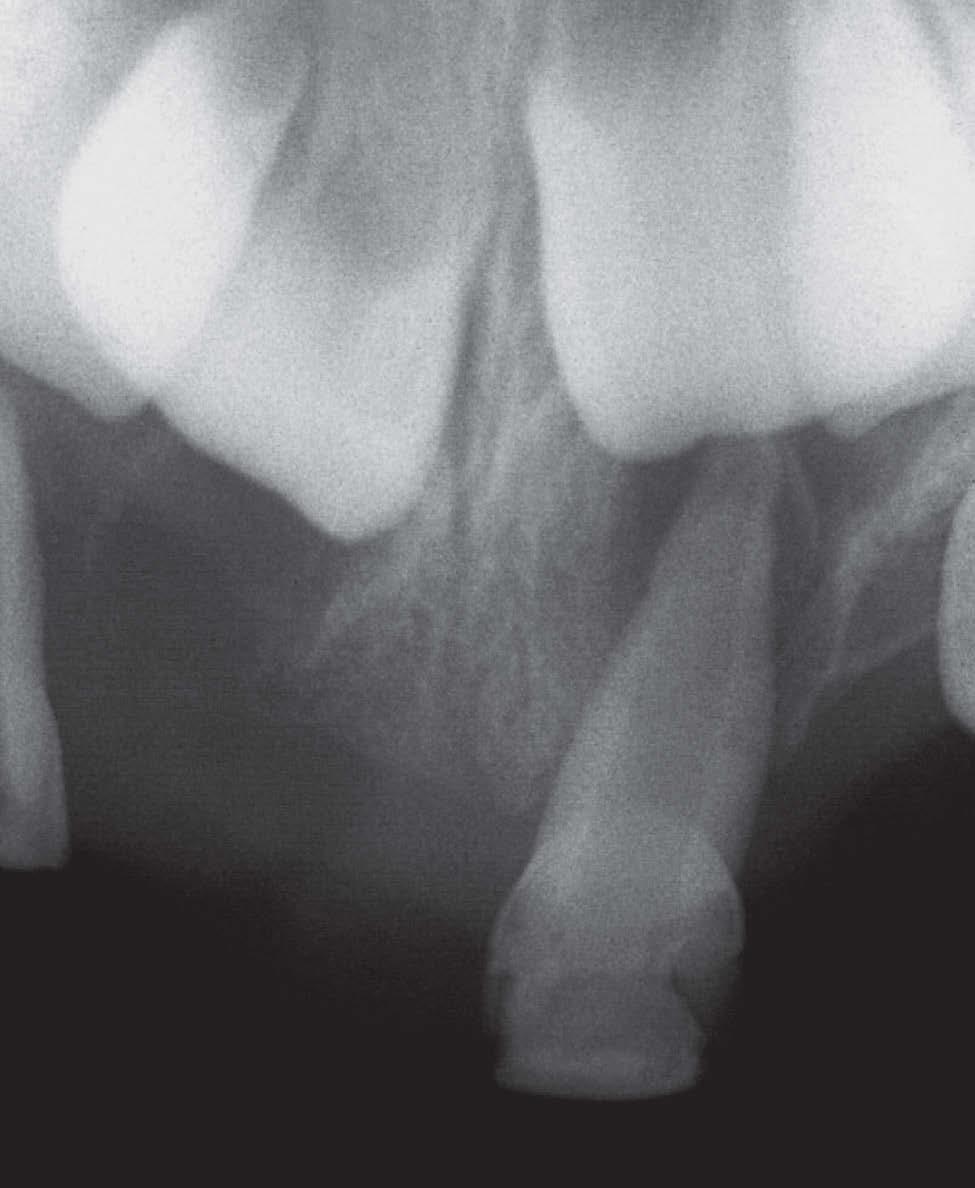 traumatismo dentário, como a intrusão do decíduo, resvalando no germe do permanente; B)