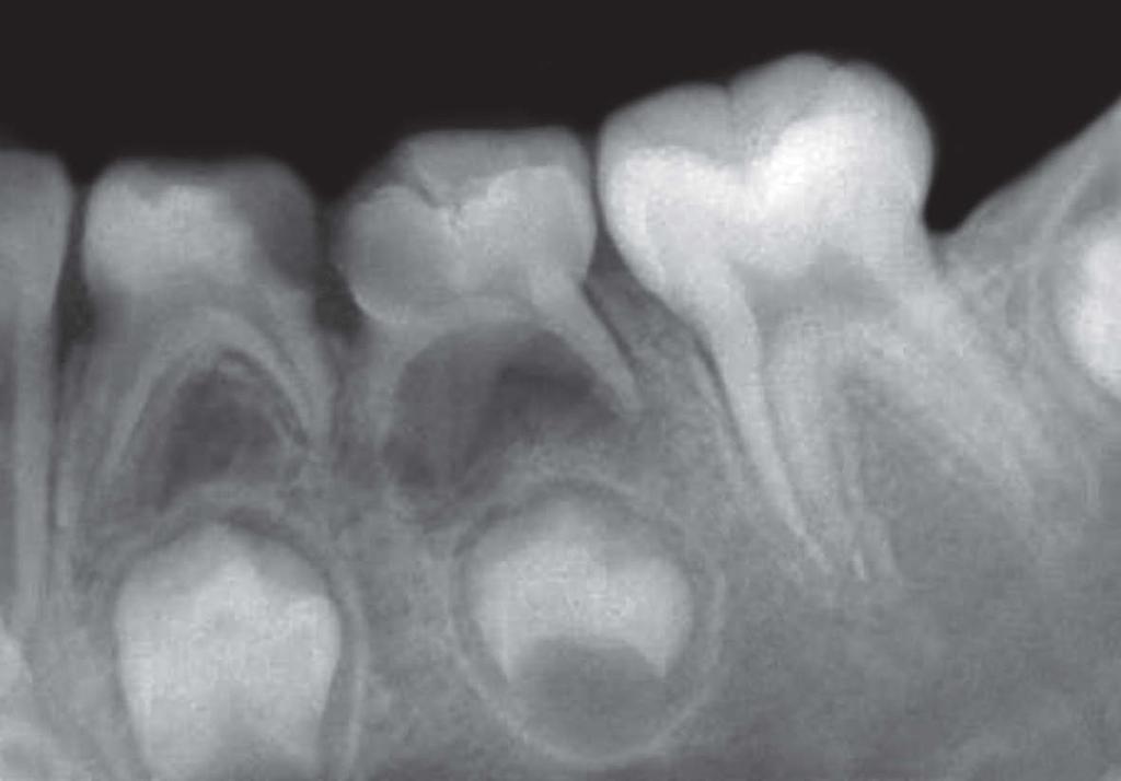 Hipoplasia do esmalte: fundamentos para nomenclatura e identificação dos tipos e causas dente na boca.