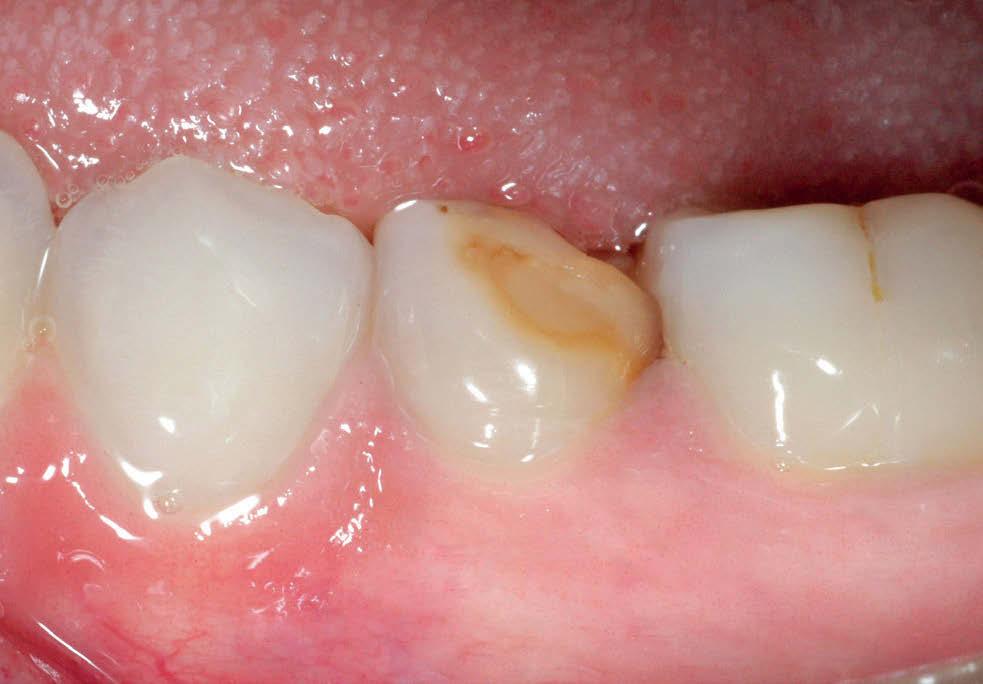 Em alguns casos clínicos, o esmalte dentário pode apresentar-se com manchas isoladas, discretas e geralmente brancas, conhecidas como Opacidades do Esmalte, e provavelmente representam hipoplasias