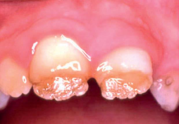 Os dentes e locais afetados dependem da idade de comprometimento do paciente, podendo envolver os decíduos, como em C.