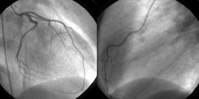 PEDRO GAMA, et al Rev Port Cardiol 2008; 27: 503-10 Figura 3. Coronariografia revelando coronárias angiograficamente normais. Figure 3.