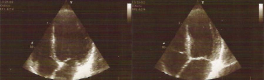 Rev Port Cardiol Vol. 27 Abril 08 / April 08 Figura 4. Ecocardiograma transtorácico realizado sete meses após o EAM. À esquerda: diástole; à direita, sístole. Figure 4.