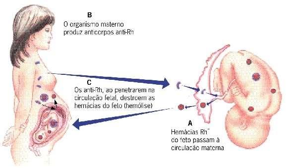 Sistema ABO Grupo Sangüíneo Aglutinogênio nas hemácias Aglutinina no plasma A A Anti-B B B Anti-A AB A e B - O - Anti-A e Anti-B Doações O A B Eritroblastose Fetal Doença Hemolítica do Recém Nascido