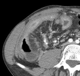 Aplicação e diagnóstico Doença de Crohn