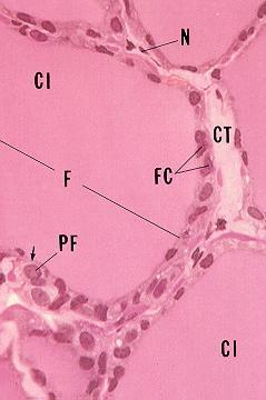 células oxífilas (poligonais, >s e citoplasma c/ grânulos